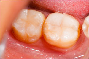 Teeth-After