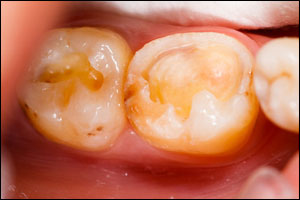 Teeth - Before