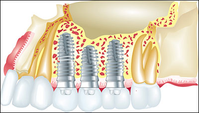 Dental Implants